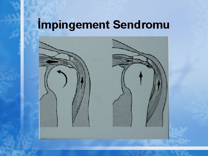 İmpingement Sendromu 