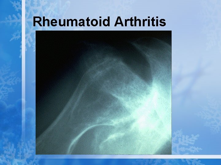 Rheumatoid Arthritis 