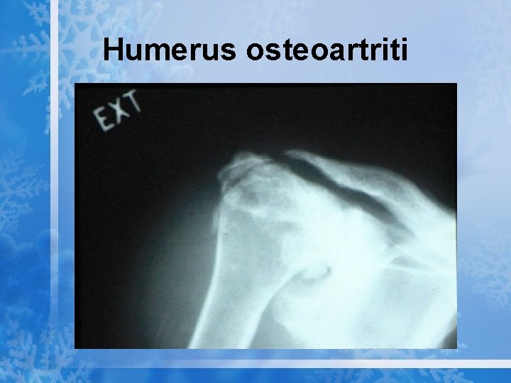 Humerus osteoartriti 