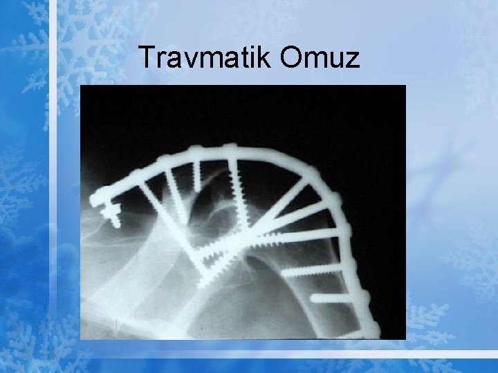 Travmatik Omuz 