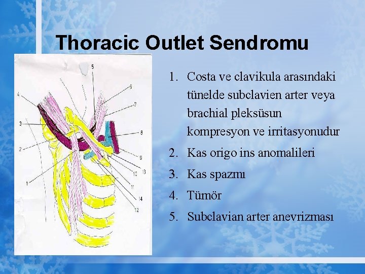 Thoracic Outlet Sendromu 1. Costa ve clavikula arasındaki tünelde subclavien arter veya brachial pleksüsun