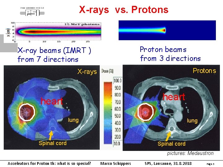 X-rays vs. Protons Proton beams from 3 directions X-ray beams (IMRT ) from 7