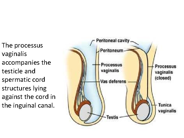 The processus vaginalis accompanies the testicle and spermatic cord structures lying against the cord