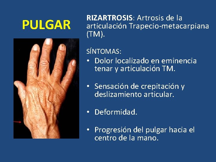 PULGAR RIZARTROSIS: Artrosis de la articulación Trapecio-metacarpiana (TM). SÍNTOMAS: • Dolor localizado en eminencia PULGAR RIZARTROSIS: Artrosis de la articulación Trapecio-metacarpiana (TM). SÍNTOMAS: • Dolor localizado en eminencia