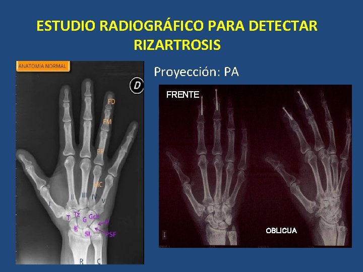 . ESTUDIO RADIOGRÁFICO PARA DETECTAR RIZARTROSIS Proyección: PA FRENTE OBLICUA . ESTUDIO RADIOGRÁFICO PARA DETECTAR RIZARTROSIS Proyección: PA FRENTE OBLICUA