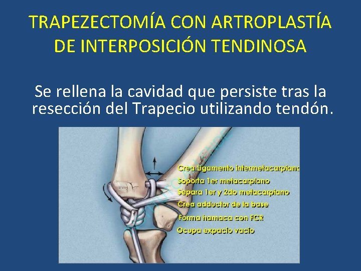 TRAPEZECTOMÍA CON ARTROPLASTÍA DE INTERPOSICIÓN TENDINOSA Se rellena la cavidad que persiste tras la TRAPEZECTOMÍA CON ARTROPLASTÍA DE INTERPOSICIÓN TENDINOSA Se rellena la cavidad que persiste tras la