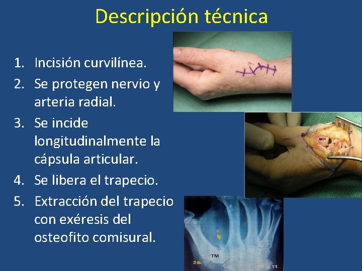 Descripción técnica 1. Incisión curvilínea. 2. Se protegen nervio y arteria radial. 3. Se Descripción técnica 1. Incisión curvilínea. 2. Se protegen nervio y arteria radial. 3. Se