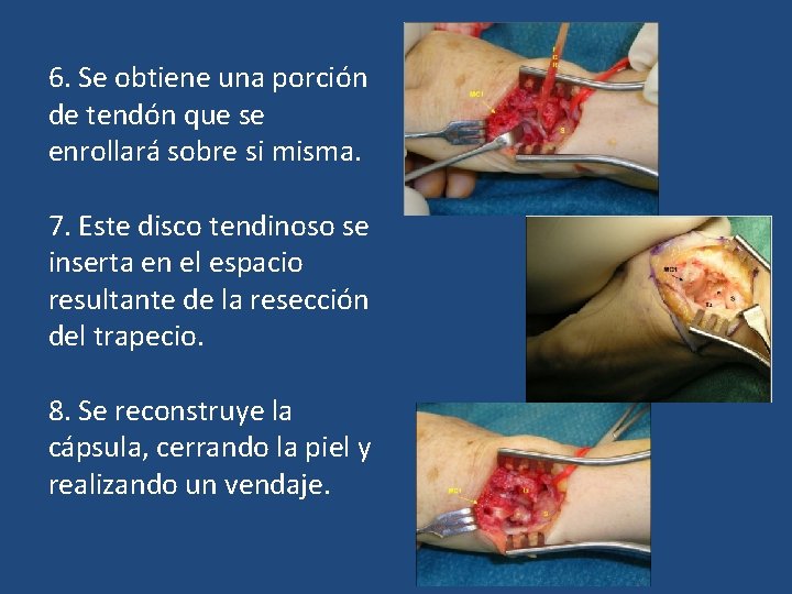 6. Se obtiene una porción de tendón que se enrollará sobre si misma. 7. 6. Se obtiene una porción de tendón que se enrollará sobre si misma. 7.