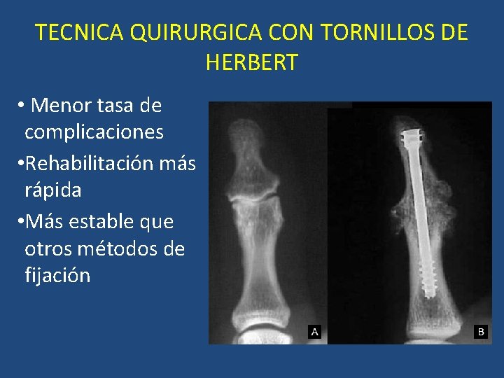 TECNICA QUIRURGICA CON TORNILLOS DE HERBERT • Menor tasa de complicaciones • Rehabilitación más TECNICA QUIRURGICA CON TORNILLOS DE HERBERT • Menor tasa de complicaciones • Rehabilitación más