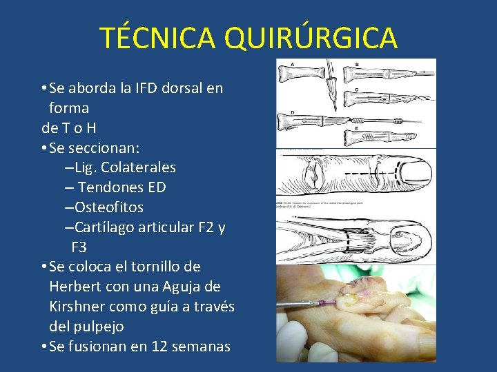 TÉCNICA QUIRÚRGICA • Se aborda la IFD dorsal en forma de T o H TÉCNICA QUIRÚRGICA • Se aborda la IFD dorsal en forma de T o H