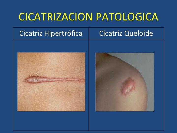 CICATRIZACION PATOLOGICA Cicatriz Hipertrófica Cicatriz Queloide CICATRIZACION PATOLOGICA Cicatriz Hipertrófica Cicatriz Queloide