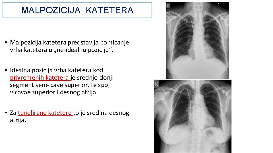 MALPOZICIJA KATETERA • Malpozicija katetera predstavlja pomicanje vrha katetera u „ne-idealnu poziciju“. • Idealna