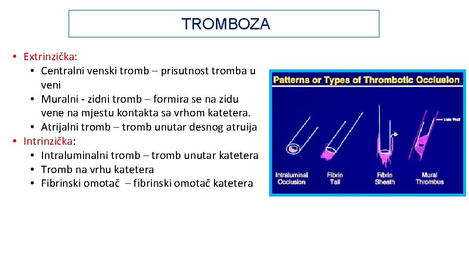 TROMBOZA • Extrinzička: • Centralni venski tromb – prisutnost tromba u veni • Muralni