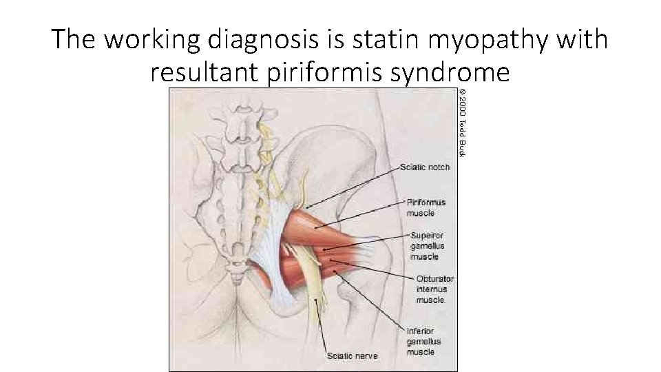 The working diagnosis is statin myopathy with resultant piriformis syndrome 