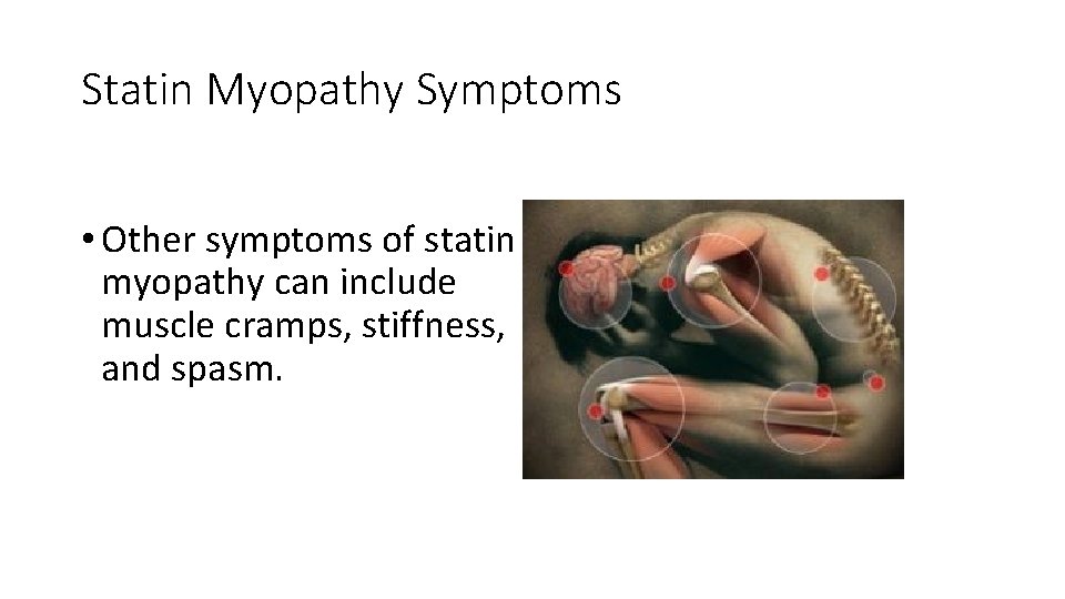 Statin Myopathy Symptoms • Other symptoms of statin myopathy can include muscle cramps, stiffness,