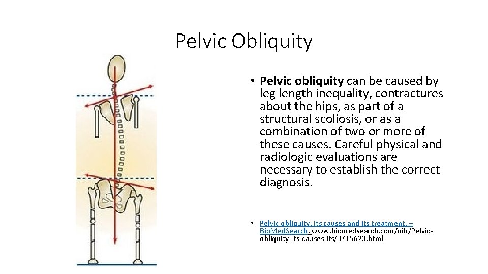 Pelvic Obliquity • Pelvic obliquity can be caused by leg length inequality, contractures about