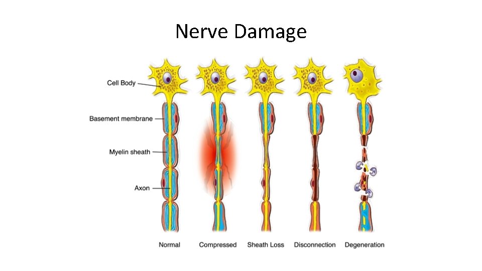 Nerve Damage 