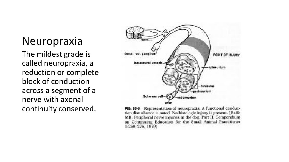 Neuropraxia The mildest grade is called neuropraxia, a reduction or complete block of conduction