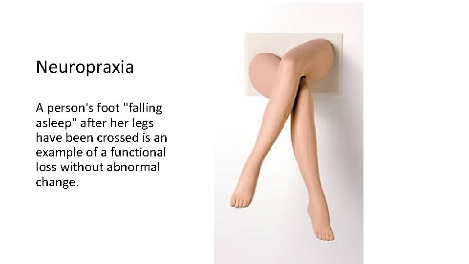 Neuropraxia A person's foot "falling asleep" after her legs have been crossed is an