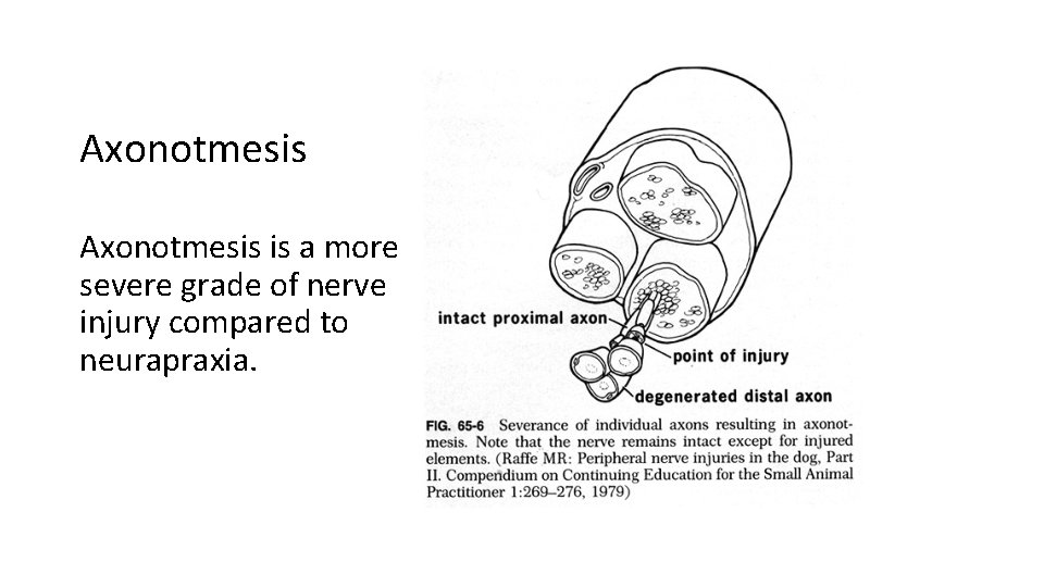 Axonotmesis is a more severe grade of nerve injury compared to neurapraxia. 