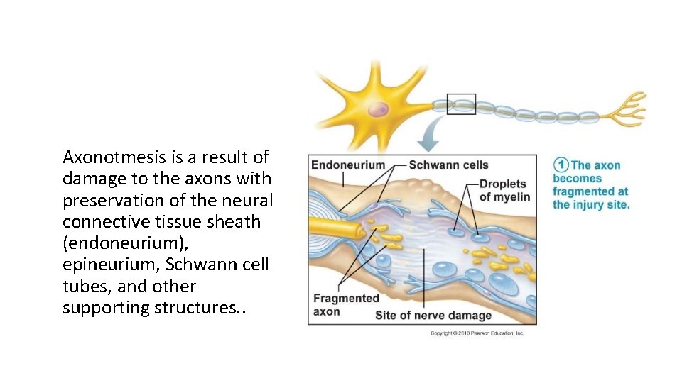 Axonotmesis is a result of damage to the axons with preservation of the neural