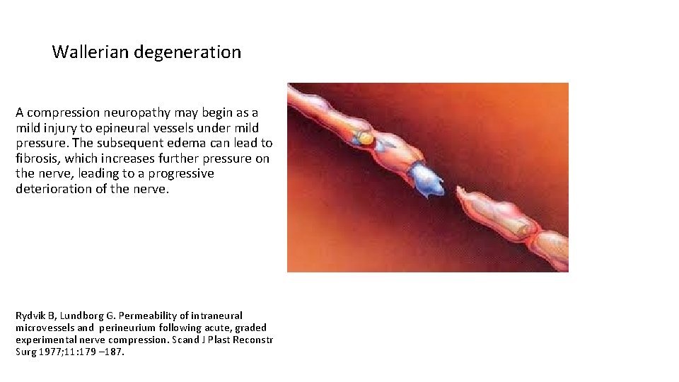 Wallerian degeneration A compression neuropathy may begin as a mild injury to epineural vessels