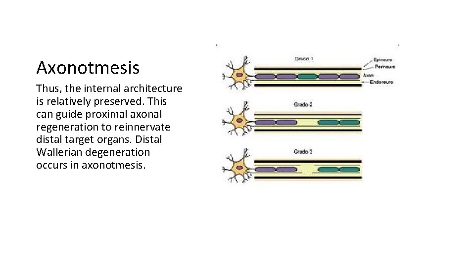Axonotmesis Thus, the internal architecture is relatively preserved. This can guide proximal axonal regeneration
