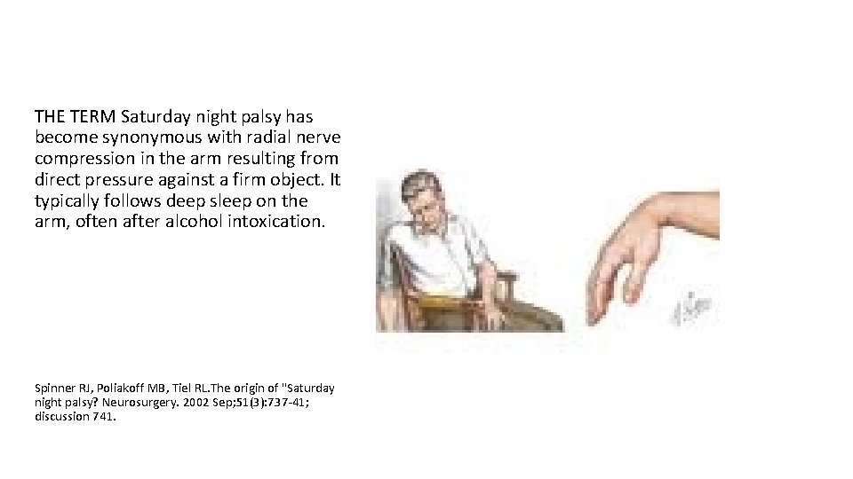 THE TERM Saturday night palsy has become synonymous with radial nerve compression in the