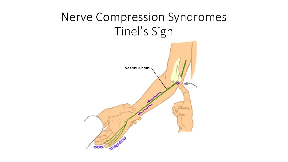 Nerve Compression Syndromes Tinel’s Sign 