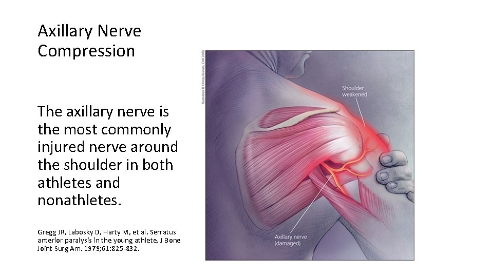 Axillary Nerve Compression The axillary nerve is the most commonly injured nerve around the