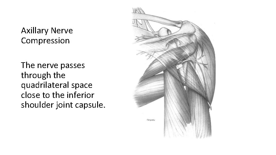 Axillary Nerve Compression The nerve passes through the quadrilateral space close to the inferior