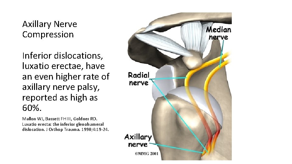 Axillary Nerve Compression Inferior dislocations, luxatio erectae, have an even higher rate of axillary