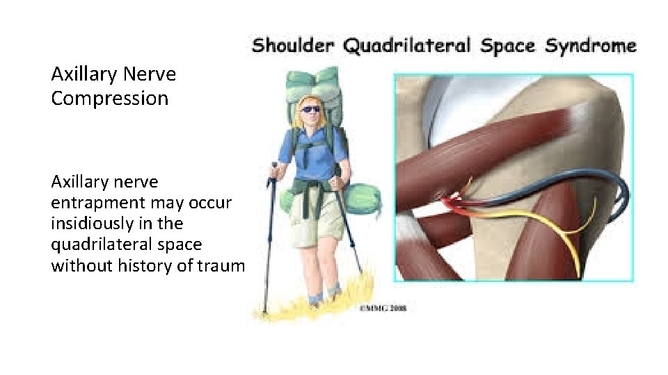 Axillary Nerve Compression Axillary nerve entrapment may occur insidiously in the quadrilateral space without