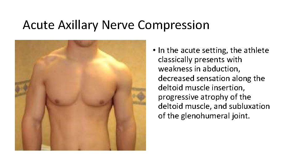 Acute Axillary Nerve Compression • In the acute setting, the athlete classically presents with