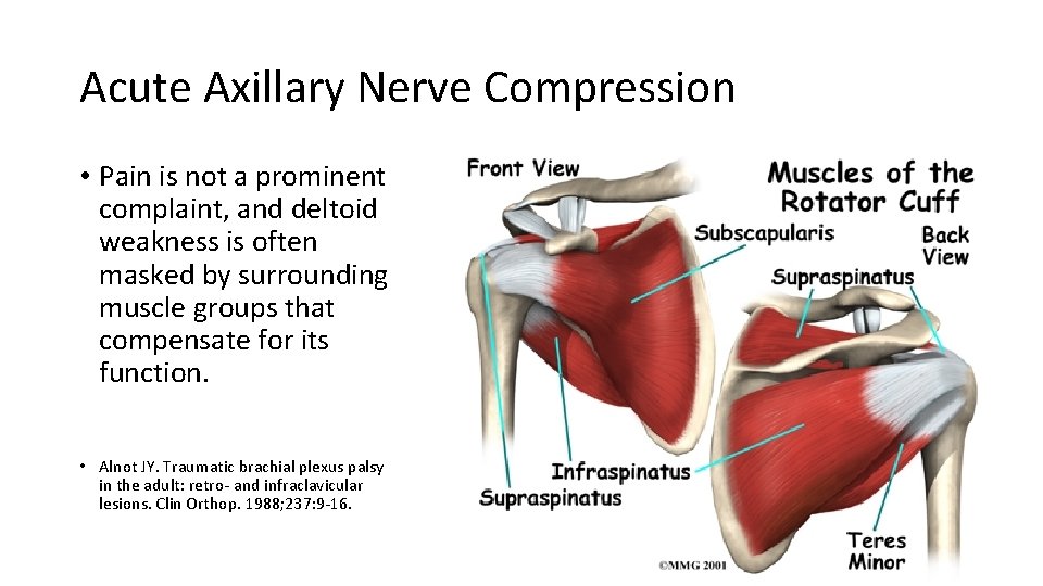 Acute Axillary Nerve Compression • Pain is not a prominent complaint, and deltoid weakness