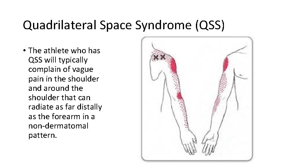 Quadrilateral Space Syndrome (QSS) • The athlete who has QSS will typically complain of