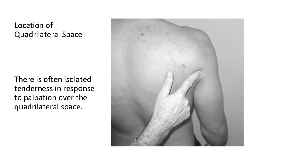 Location of Quadrilateral Space There is often isolated tenderness in response to palpation over