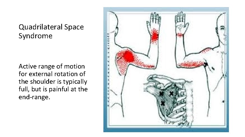 Quadrilateral Space Syndrome Active range of motion for external rotation of the shoulder is
