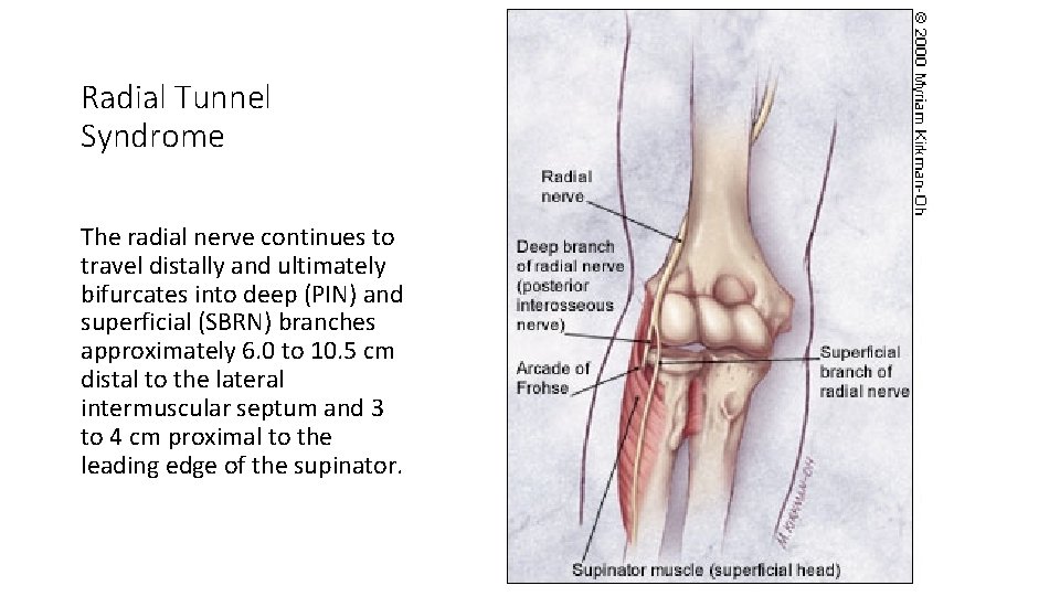 Radial Tunnel Syndrome The radial nerve continues to travel distally and ultimately bifurcates into