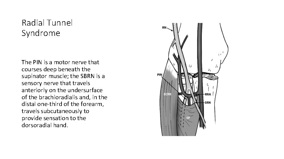 Radial Tunnel Syndrome The PIN is a motor nerve that courses deep beneath the