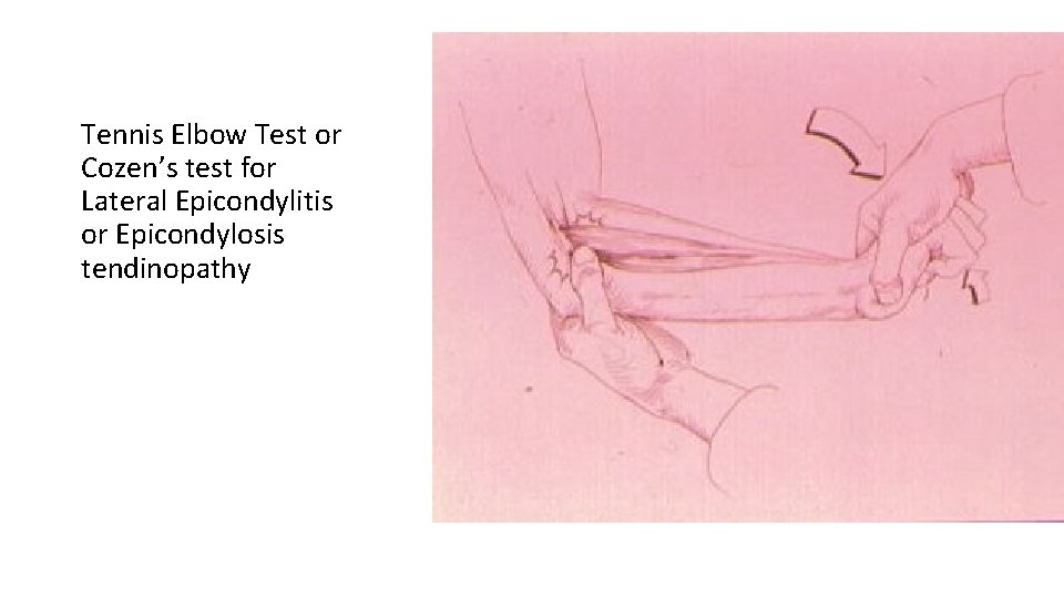 Tennis Elbow Test or Cozen’s test for Lateral Epicondylitis or Epicondylosis tendinopathy 