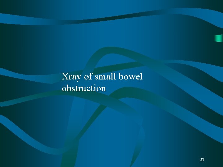 Xray of small bowel obstruction 23 Xray of small bowel obstruction 23