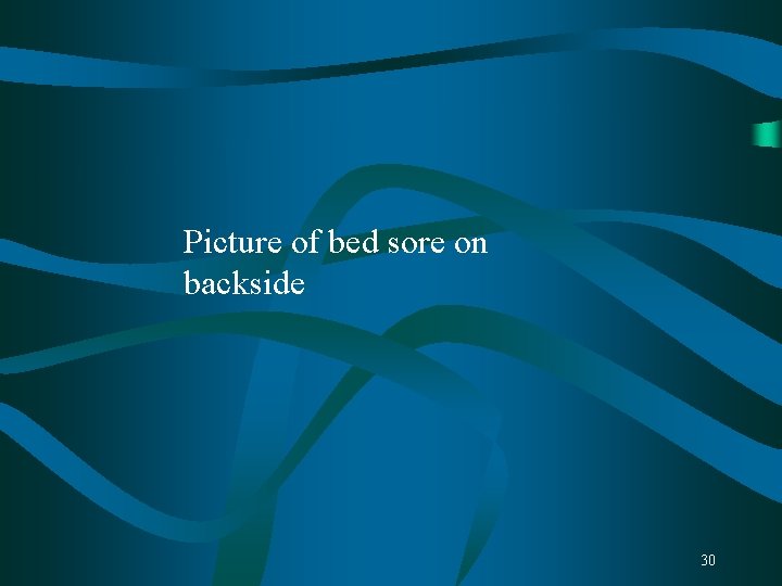 Picture of bed sore on backside 30 Picture of bed sore on backside 30