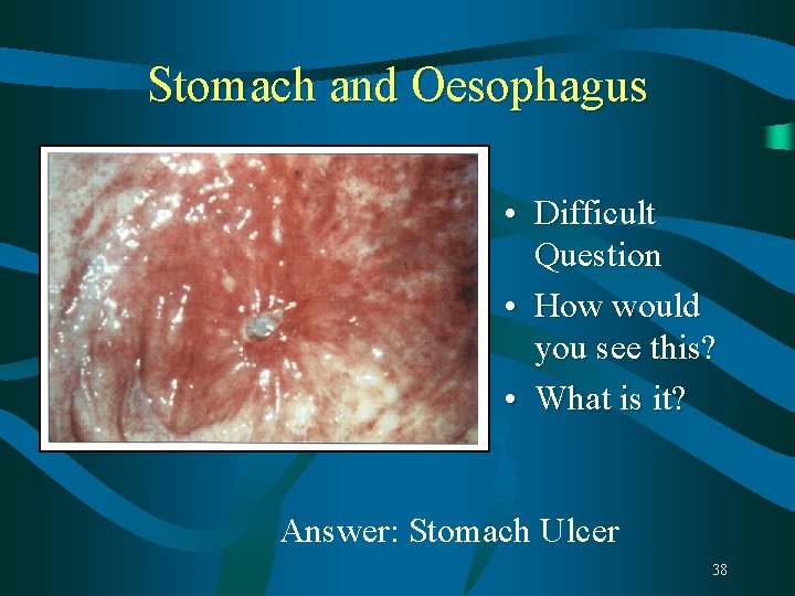 Stomach and Oesophagus • Difficult Question • How would you see this? • What Stomach and Oesophagus • Difficult Question • How would you see this? • What
