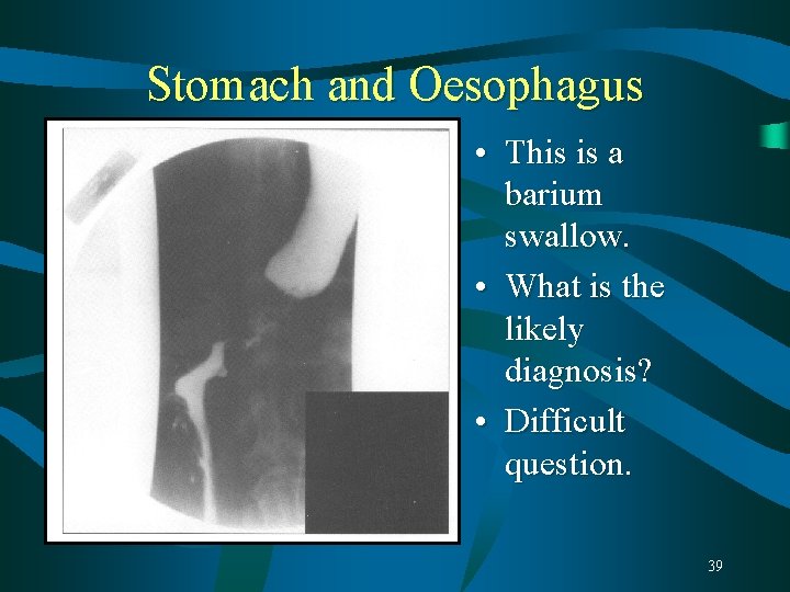 Stomach and Oesophagus • This is a barium swallow. • What is the likely Stomach and Oesophagus • This is a barium swallow. • What is the likely