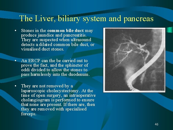 The Liver, biliary system and pancreas • Stones in the common bile duct may The Liver, biliary system and pancreas • Stones in the common bile duct may