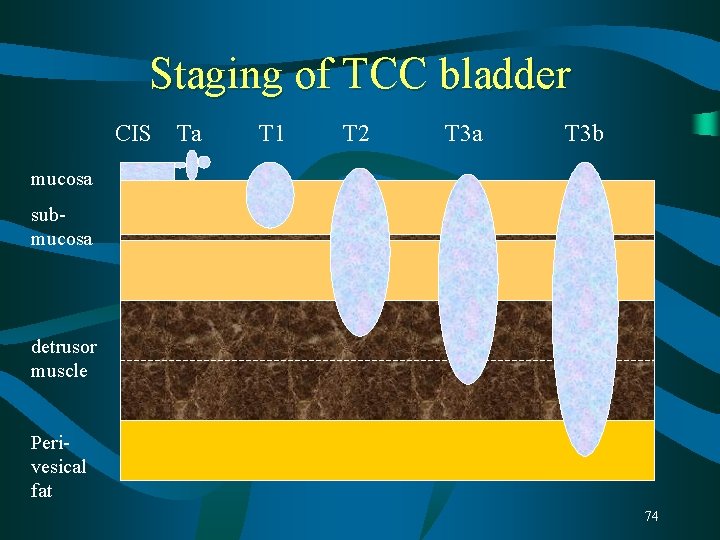 Staging of TCC bladder CIS Ta T 1 T 2 T 3 a T Staging of TCC bladder CIS Ta T 1 T 2 T 3 a T