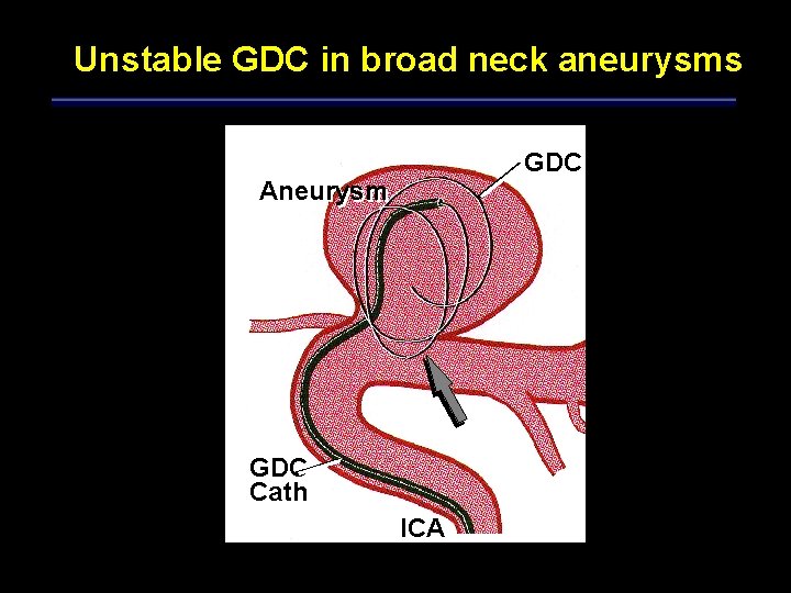 Unstable GDC in broad neck aneurysms GDC Aneurysm GDC Cath ICA 