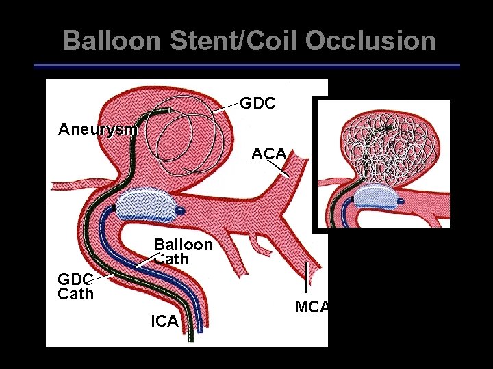 Balloon Stent/Coil Occlusion GDC Aneurysm ACA Balloon Cath GDC Cath ICA MCA 