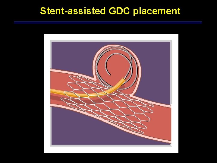 Stent-assisted GDC placement 